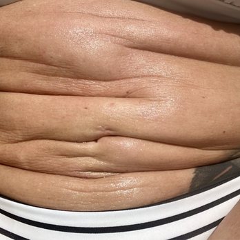 Cosmetic Surgery Affiliates - Abdomen post surgery - Cosmetic Surgeons Near Me - Oklahoma City, Oklahoma Cosmetic Surgery Affiliates - Abdomen post surgery - Cosmetic Surgeons Near Me - Oklahoma City, Oklahoma