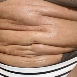 Cosmetic Surgery Affiliates - Abdomen post surgery