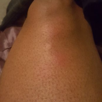 Turkey Run State Park - Bug bites - Parks Near Me - Marshall, Indiana