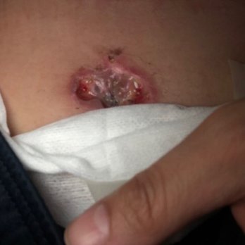 Spectrum Aesthetics - Infected belly button (this was AFTER it had begun to heal so you can imagine). - Medical Spas Near Me - Miami, Florida Spectrum Aesthetics - Infected belly button (this was AFTER it had begun to heal so you can imagine). - Medical Spas Near Me - Miami, Florida