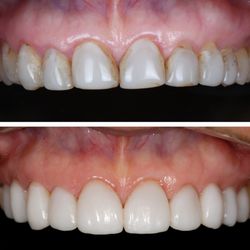 Dentistry By Design - 3D printed veneers