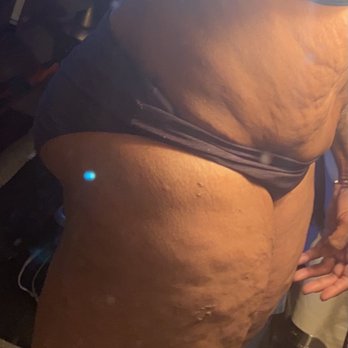 Belcara Health - TT/BBL final results - Medical Spas Near Me - Baltimore, Maryland