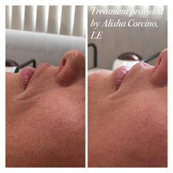 Alisha's Spa Euphoria - Before/After, notice the reduction in wrinkle depth, smoother skin and improved texture and tone.