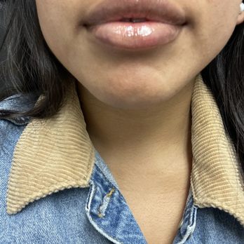 NakedMD - Lip filler - Medical Spas Near Me - Downey, California