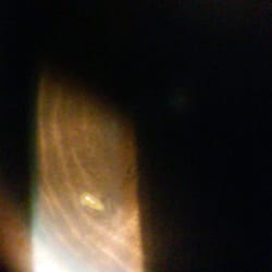 Jason M Bart- Ultra Vision Optical Center - Splinter Dr. Bart removed from my cornia.