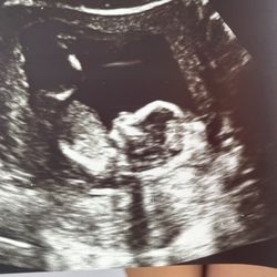 Babyview 3D/4D Ultrasounds