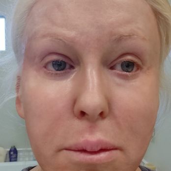 Robert Shumway, MD - No makeup. Taken the day before CO2 from my home. My CO2 was on Dec 16, 2019. - Cosmetic Surgeons Near Me - San Diego, California Robert Shumway, MD - No makeup. Taken the day before CO2 from my home. My CO2 was on Dec 16, 2019. - Cosmetic Surgeons Near Me - San Diego, California