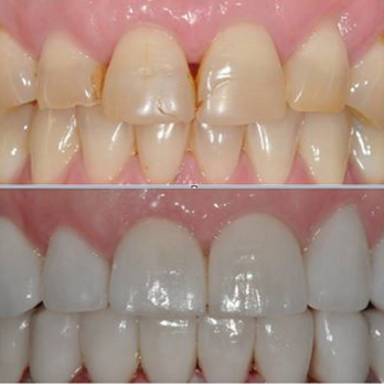 Stonehill Dental - Porcelain Veneers (Before/After) - Cosmetic Dentists Near Me - Hamilton, Ontario Stonehill Dental - Porcelain Veneers (Before/After) - Cosmetic Dentists Near Me - Hamilton, Ontario