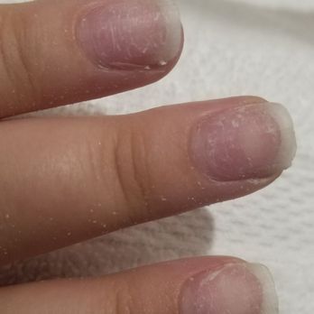 Prim Nails Spa Lounge - My natural nails after they ripped the acrylic off. - Nail Salons Near Me - Happy Valley, Oregon Prim Nails Spa Lounge - My natural nails after they ripped the acrylic off. - Nail Salons Near Me - Happy Valley, Oregon