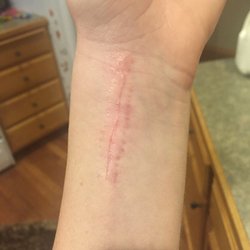 Performance Physical Therapy & Hand Center - Six weeks after surgery and about three weeks of therapy
