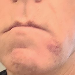 Swollen & bruised for days. One side of my mouth now hangs down! Swollen & bruised for days. One side of my mouth now hangs down!