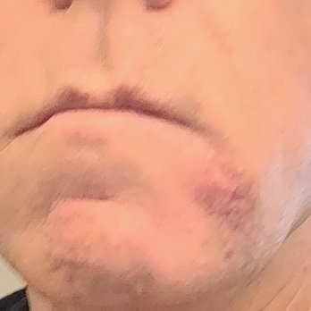 No Lines By Design - Swollen & bruised for days. One side of my mouth now hangs down! - Medical Spas Near Me - Las Vegas, Nevada No Lines By Design - Swollen & bruised for days. One side of my mouth now hangs down! - Medical Spas Near Me - Las Vegas, Nevada