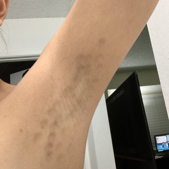 Skin Theory - Five months - Laser Hair Removal Near Me - Corona, California Skin Theory - Five months - Laser Hair Removal Near Me - Corona, California