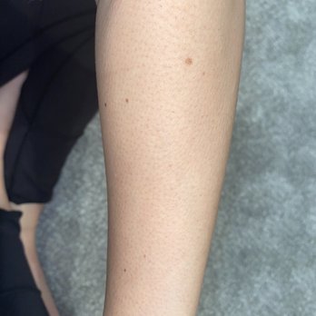 LightRx - Canton - Laser hair removal results after 4 sessions to the arm - Medical Spas Near Me - Canton, Michigan LightRx - Canton - Laser hair removal results after 4 sessions to the arm - Medical Spas Near Me - Canton, Michigan
