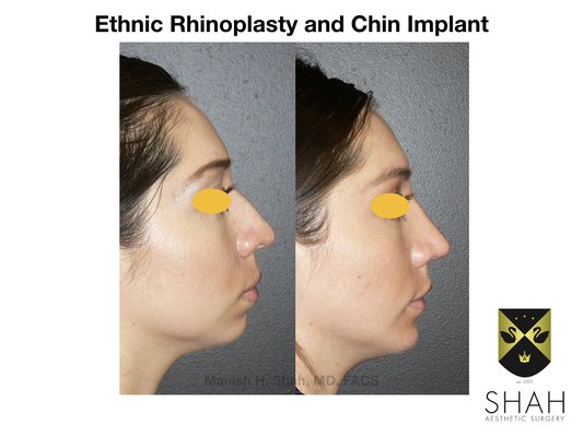 Shah Aesthetic Surgery - Rhinoplasty and Facelift Specialist by null