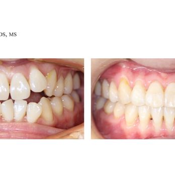 David Choe, DDS - Crowding Correction - Orthodontists Near Me - Cerritos, California David Choe, DDS - Crowding Correction - Orthodontists Near Me - Cerritos, California