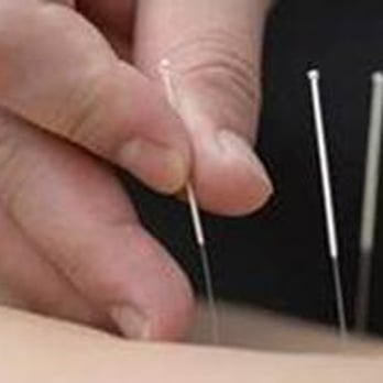 360 Physical Therapy - Dry Needling is a specialized treatment technique that uses thin filament needles to treat various musculoskeletal disorders. - Physical Therapy Near Me - Phoenix, Arizona