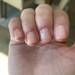 Over buffed nails and skinned fingers