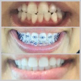 1 year of traditional metal braces. Transformation!