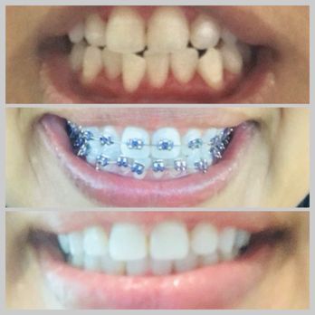 Natalie Yang Orthodontics - 1 year of traditional metal braces. Transformation! - Orthodontists Near Me - Vacaville, California
