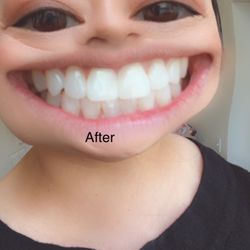 Villa Vista Dental - After fixing discoloration and cavity