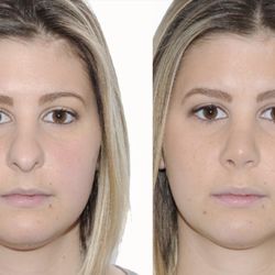James Goodnight, MD - Everlasting Beauty - Rhinoplasty