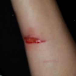 Central Harnett Hospital - My booboo