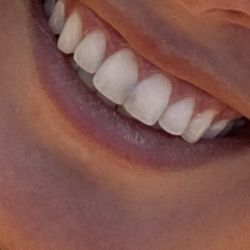 Pittsford Dental Excellence Center - Darkness between my teeth. All photos I have taken have a filter over them to try and make it not look so bad.