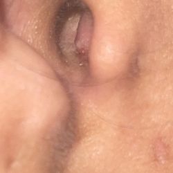 Campbell Ear Nose & Throat - The next morning (clearly an abscess) as I stated to Dr. Campbell!