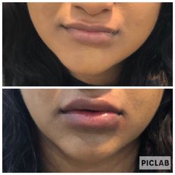 Dolce Aesthetics - Lips Botox Juvederm