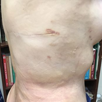 LA Cryo - Hard to believe that all of my bruising was gone after one treatment, but it was 100% true. - Cryotherapy Near Me - Pasadena, California LA Cryo - Hard to believe that all of my bruising was gone after one treatment, but it was 100% true. - Cryotherapy Near Me - Pasadena, California
