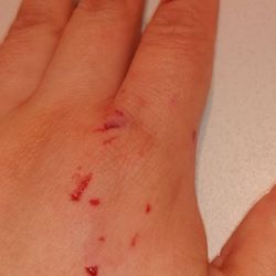 Dallas Police Department - Had blood on my shirt because my blood kept flowing throughout the night from one of the finger wounds. Photo after going to a doctor.