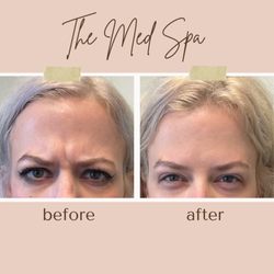 The Med Spa - Botox Before and After