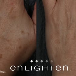 Enlighten Aesthetic of Cleveland - Enlighten Aesthetic of Cleveland - Skin Pigment Before and After - Cutera Enlighten Laser Tattoo Removal