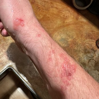 Lithia Springs Resort - Bed bug bites from our stay at Lithia. - Resorts Near Me - Ashland, Oregon Lithia Springs Resort - Bed bug bites from our stay at Lithia. - Resorts Near Me - Ashland, Oregon