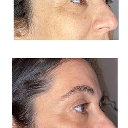Etina Beauty - Fibroblast Patas de gallo