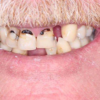 New Image Dentistry - Barry needed a solution for his smile. - Cosmetic Dentists Near Me - Franklin, Tennessee New Image Dentistry - Barry needed a solution for his smile. - Cosmetic Dentists Near Me - Franklin, Tennessee