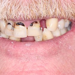 New Image Dentistry - Barry needed a solution for his smile.