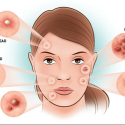 Acne Treatment Las Vegas - By the end of our treatments, you'll notice your skin will permanently change to a normal skin type and your pores will shrink.