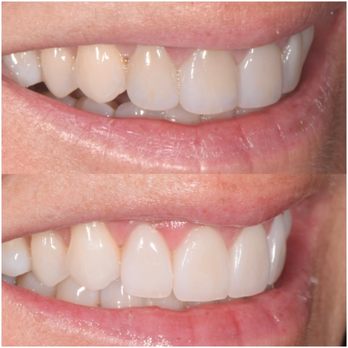 Dentique - Before and after - Cosmetic Dentists Near Me - San Diego, California Dentique - Before and after - Cosmetic Dentists Near Me - San Diego, California