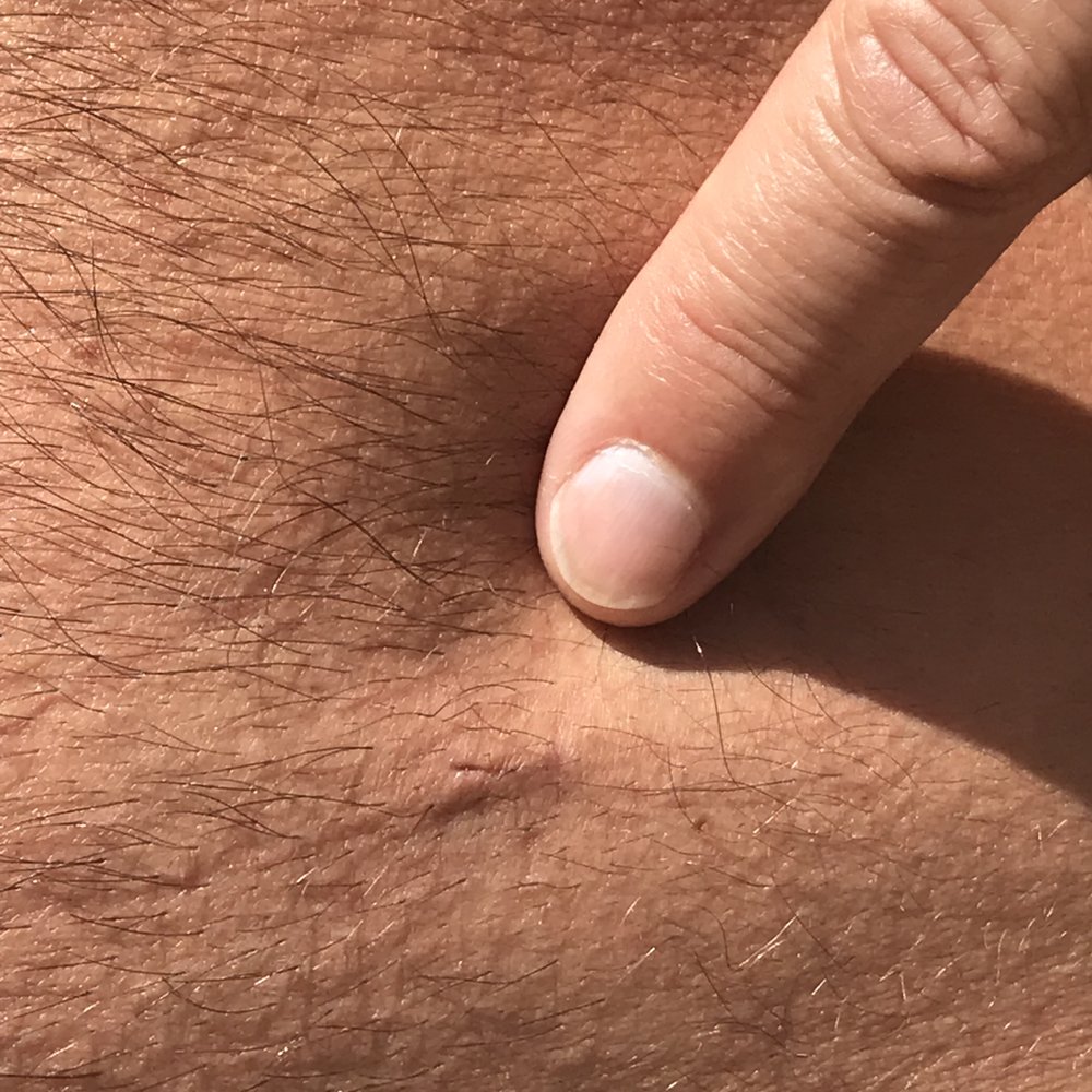 David Thoman, MD - right abdominal incision 23 days after surgery - Gastroenterologist Near Me David Thoman, MD - right abdominal incision 23 days after surgery - Gastroenterologist Near Me