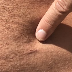 David Thoman, MD - Right abdominal incision 23 days after surgery