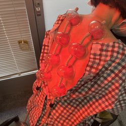 Walnut Creek Acupuncture - Cupping! The best part!