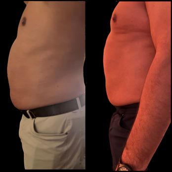 Body Sculpting Santa Barbara - AI-powered body sculpting: melt 2-3 inches off your stomach in 4 hours. Smart, fast, non-invasive. - Body Contouring Near Me - Santa Barbara, California Body Sculpting Santa Barbara - AI-powered body sculpting: melt 2-3 inches off your stomach in 4 hours. Smart, fast, non-invasive. - Body Contouring Near Me - Santa Barbara, California