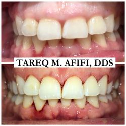 Chino Valley Smile Center - Before and After!!! Gingivectomy is a procedure that changes the shape of your gums to eliminate deep pockets making it easier to brush.