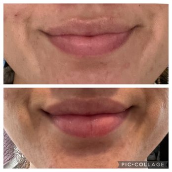 El Segundo Dermatology - Lip flip results after 5 days - Dermatologists Near Me - El Segundo, California El Segundo Dermatology - Lip flip results after 5 days - Dermatologists Near Me - El Segundo, California