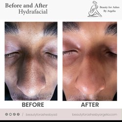 Beauty for ashes - Before and after Hydafacial