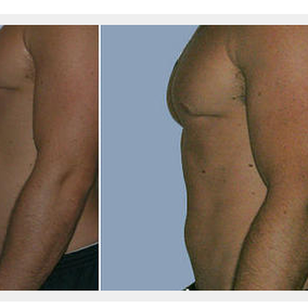 hallandale lipo c ISLIM LIPO - Updated May 2026 - 815 SE 1st Ave, Hallandale Beach, Florida -  Weight Loss Centers - Phone Number