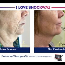 Esteem Treatments - This is a before and an after 6 treatments with our flashwave facial treatment.