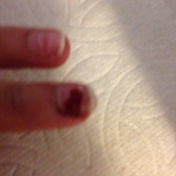Fairy's Nails - Picture of her bleeding nail. - Nail Salons Near Me - Culver City, California